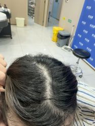 -碧莲盛不剃发植发