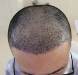 -大麦微针植发丨全国连锁