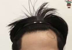 -大麦微针植发全国连锁