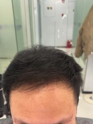 体验后-大麦微针植发丨全国连锁