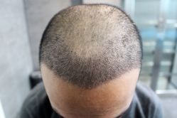 -大麦微针植发丨全国连锁