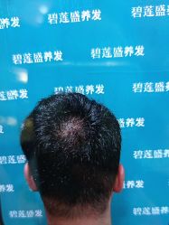 -碧莲盛·不剃发植发