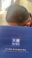 -大麦微针植发丨全国连锁