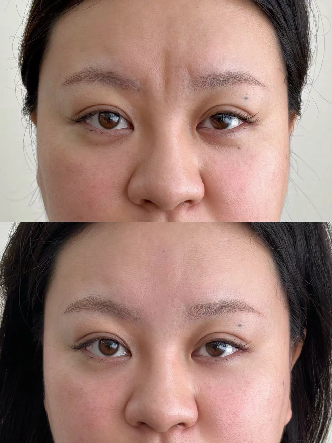 三角区凹陷
这次跟我填充的医生超稳的耶
真的是对着我的纹路一点