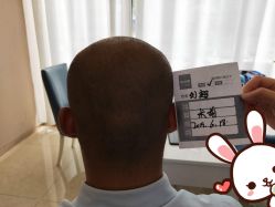 点击看大图 -大麦微针植发丨全国连锁