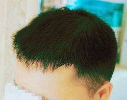 -大麦微针植发丨全国连锁