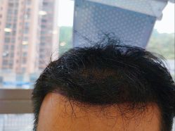 -碧莲盛·不剃发植发