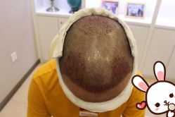 点击看大图 -大麦微针植发丨全国连锁