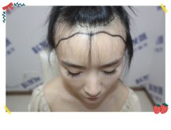 -大麦微针植发全国连锁