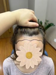 点击看大图 体验前-大麦微针植发全国连锁