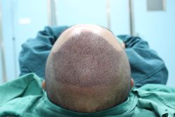 点击看大图 -大麦微针植发丨全国连锁