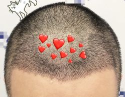 -大麦微针植发全国连锁