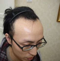 -大麦微针植发丨全国连锁