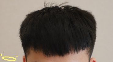 -大麦微针植发丨全国连锁