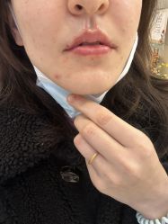 体验后-More摩尔医美の注射线雕光电中心