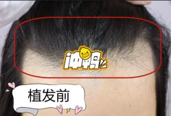 -大麦微针植发全国连锁