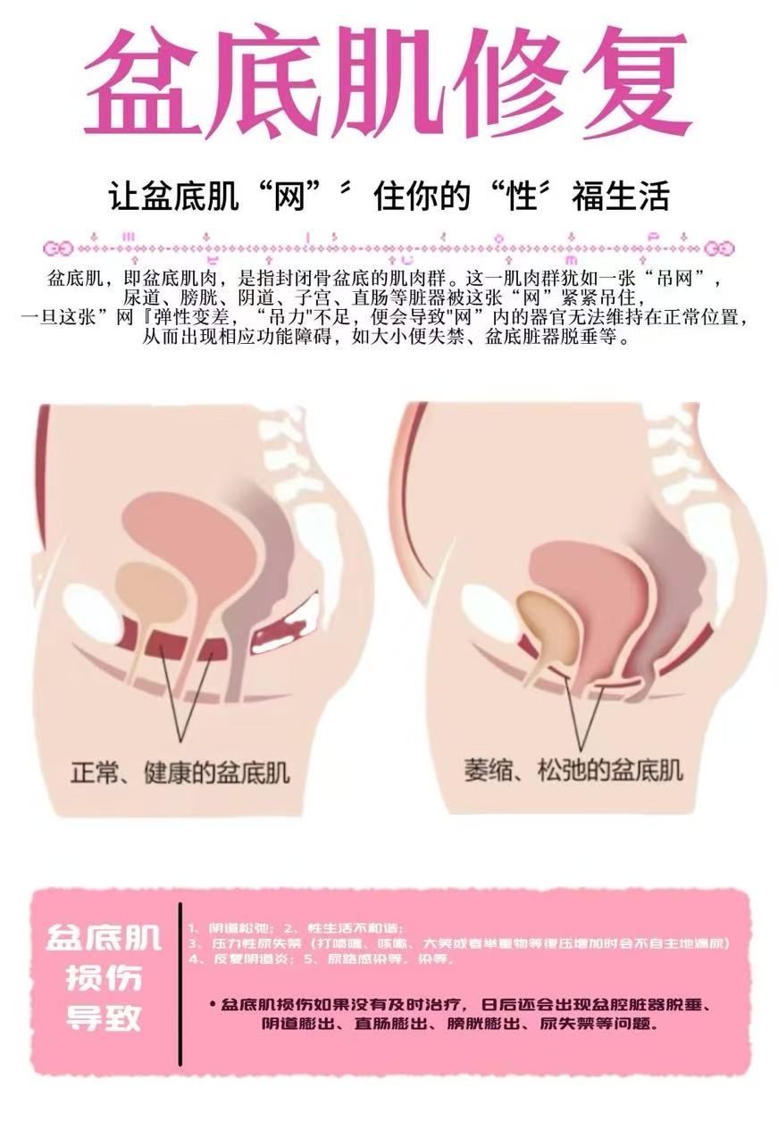 盆底肌托起的是女性的生命与尊严
