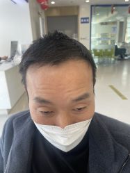 体验后-大麦微针植发全国连锁