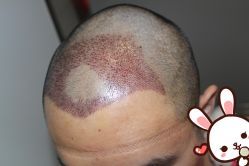 -大麦微针植发丨全国连锁