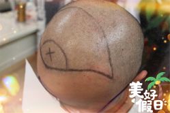 -大麦微针植发全国连锁