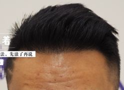 -大麦微针植发全国连锁