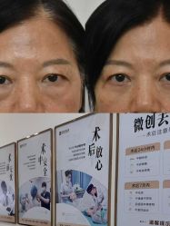 -广州健丽·去眼袋医疗美容机构