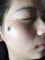 -美丽人生祛斑扁平疣汗管瘤中心