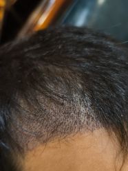 -碧莲盛·不剃发植发