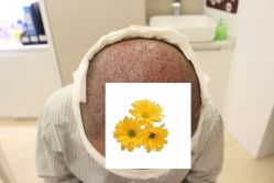 -大麦微针植发丨全国连锁