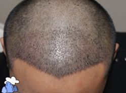 -大麦微针植发丨全国连锁