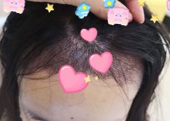 -大麦微针植发全国连锁