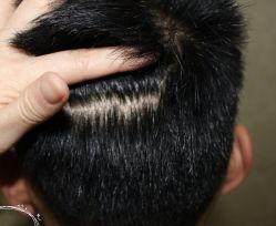 -大麦微针植发丨全国连锁