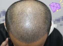 -大麦微针植发丨全国连锁