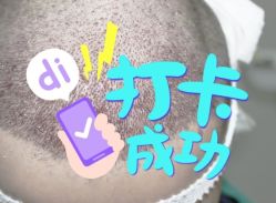 -大麦微针植发全国连锁