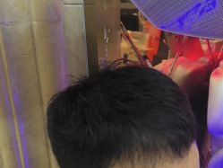 -碧莲盛·不剃发植发