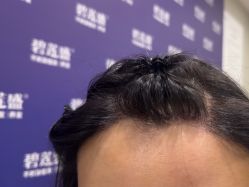 -碧莲盛·不剃发植发