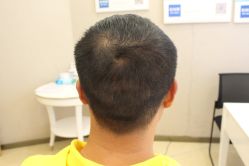 点击看大图 -大麦微针植发丨全国连锁