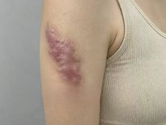 -杭州仁易堂中医康复医院疤痕修复