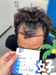 点击看大图 -大麦微针植发全国连锁