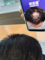 -碧莲盛·不剃发植发