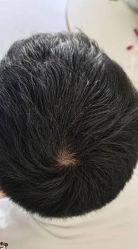 -大麦微针植发丨全国连锁