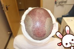 -大麦微针植发丨全国连锁