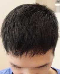 -大麦微针植发丨全国连锁