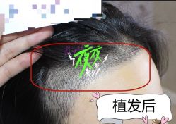 -大麦微针植发全国连锁