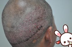 -大麦微针植发丨全国连锁