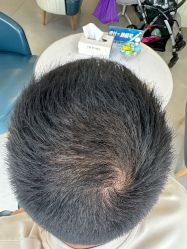 -大麦微针植发全国连锁