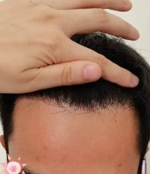 -大麦微针植发丨全国连锁