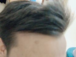 -碧莲盛·不剃发植发