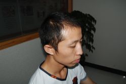 -大麦微针植发丨全国连锁