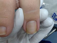 -Andrew指甲专科灰指甲·甲沟炎矫正·3D步态矫形鞋垫定制(上海法华镇路旗舰店)